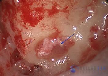 Posterior Semicircular Canal Occlusion Cases