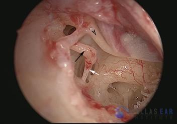 Otosclerosis and stapes surgery — Hearing Institute