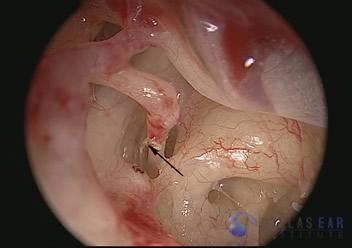 Stapedectomy Case