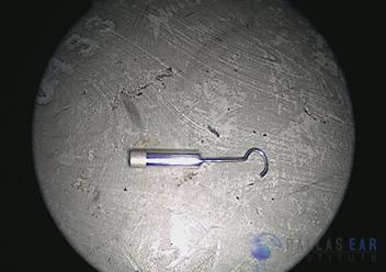 Stapedectomy Case