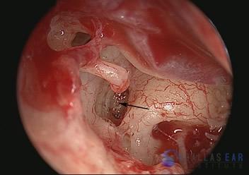 Stapedectomy Case