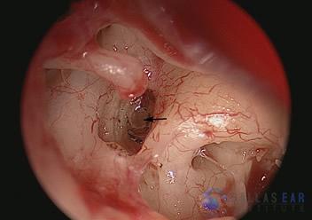 Stapedectomy Case