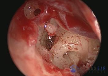 Stapedectomy Case