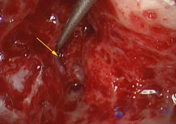 Superior Semicircular Canal Dehiscence (SSCD)