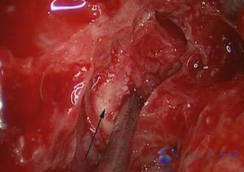 Superior Semicircular Canal Dehiscence (SSCD)