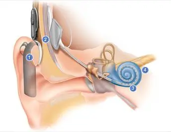 Diagram of how a cochlear implant works